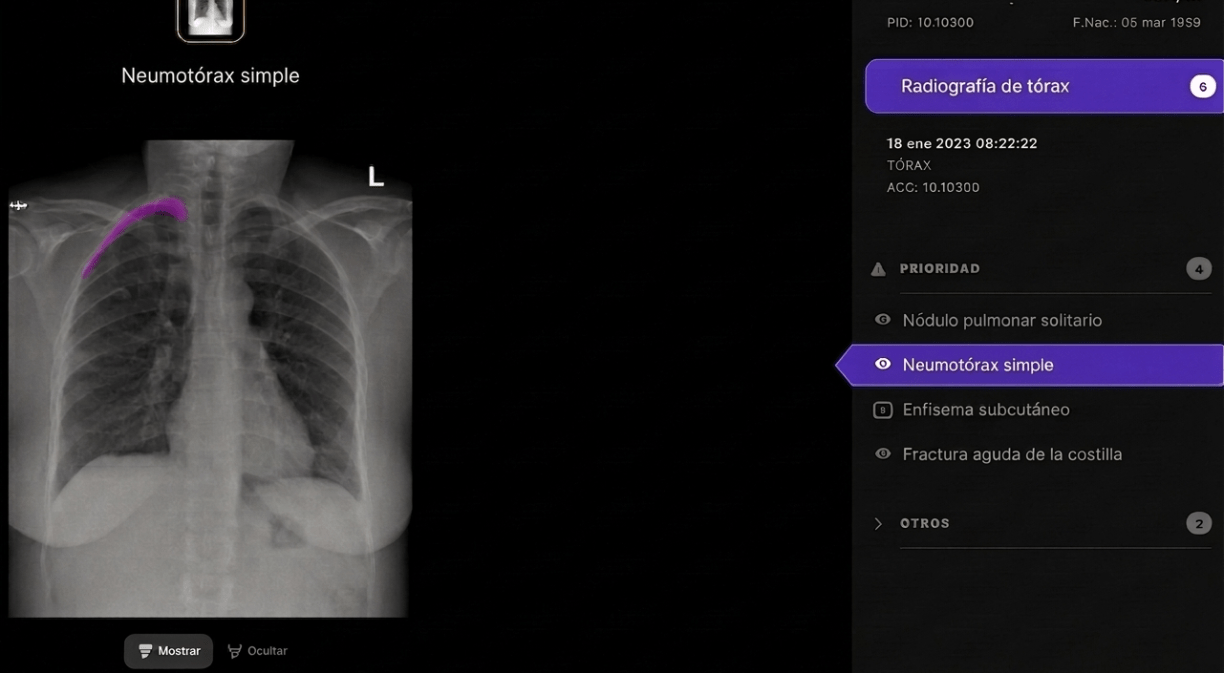 Visualización de resultados del algoritmo sobre una radiografía de tórax en el visor de la solución (los datos son simulados)