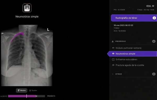 Visualización de resultados del algoritmo sobre una radiografía de tórax en el visor de la solución (los datos son simulados)