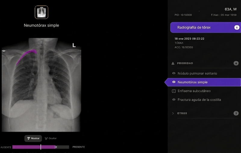 Visualización de resultados del algoritmo sobre una radiografía de tórax en el visor de la solución (los datos son simulados)